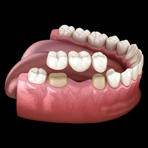 Dental-Bridges Dental-Bridges