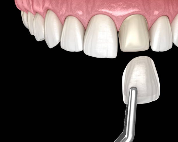 Porcelain Veneer