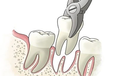 Tooth extraction Lifetime Dental