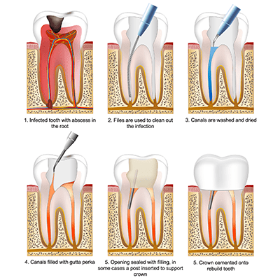 Root Canal Lifetime Dental