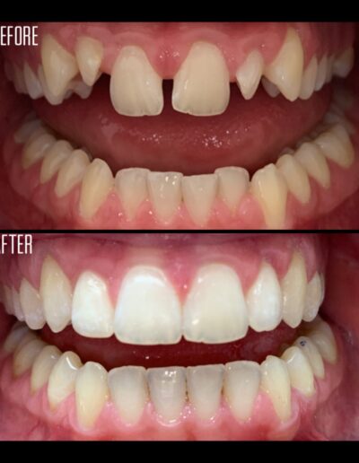 Invisalign before and after
